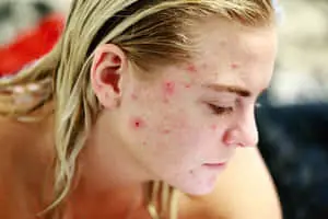 Bruised Girl Side View